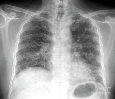 Pulmonary Fibrosis Photograph By Science Photo Library Pixels