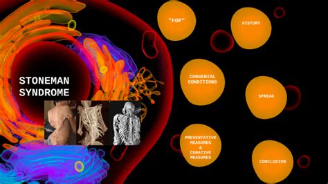 Stoneman Syndrome by Yamile Perez on Prezi