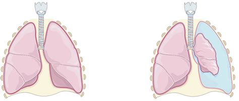 Tension Pneumothorax Diagram | Quizlet