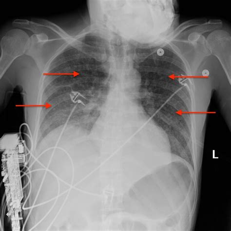 A Case Report On Miliary Tuberculosis In Acute Immune Reconstitution