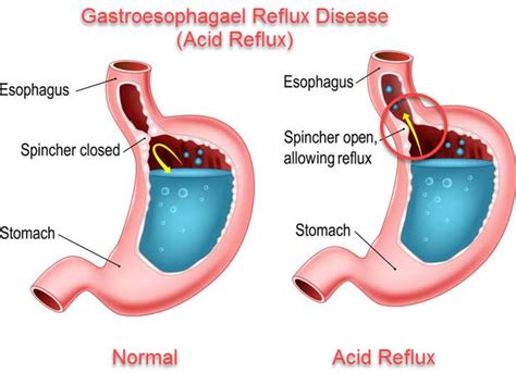 Acid Reflux - Mahaba Herbal Limited