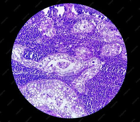 Premium Photo | Photomicrograph of adenocarcinoma of stomach or stomach