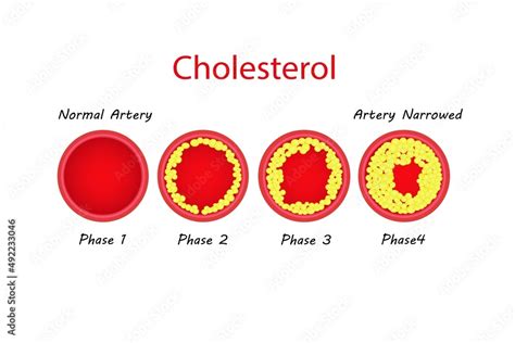 Coronary Artery Disease Is The Buildup Of Plaque In The Arteries That