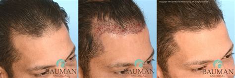 Anatomy Of An Undetectable Hair Transplant By Dr Alan J Bauman