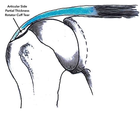 Supraspinatus Tendon Tear Treatment