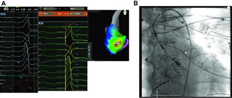 A Activation Mapping Of The Left Ventricular Outflow Tract Lvot