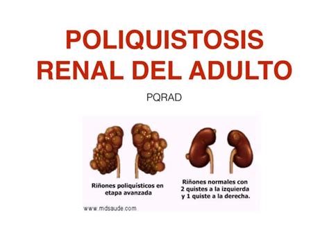 Poliquistosis Renal En El Adulto Ppt