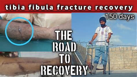 Tibia Fibula Fracture Recovery My Journey 150 Days The Road To Recovery