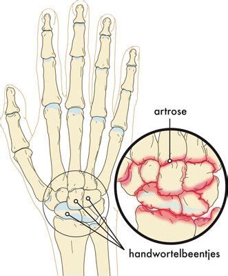 Artrose Aan Hand Of Pols Oorzaak Symptomen En Behandeling