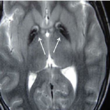 Axial Gre Image Of Brain Showing Hypo Intense Signals In Bilateral