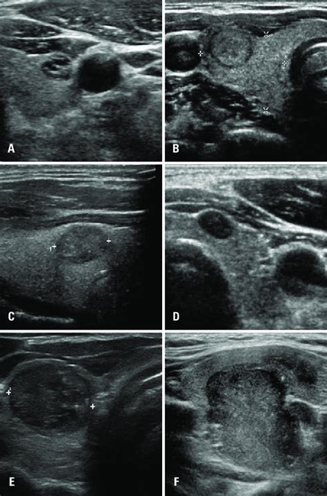 Examples Of Thyroid Nodules Submitted To Cytological Examination A Download Scientific