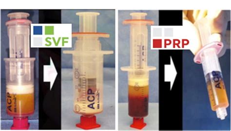Peri Anal Fistula PRPSclinics
