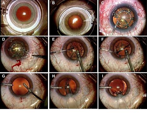 Figure 1 From Clinical Ophthalmology Dovepress Dovepress First