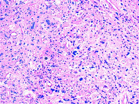 Pathology Outlines Pleomorphic Liposarcoma