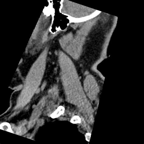 Cervical Spinal Neurofibroma In A Patient With Nf Radiopaedia