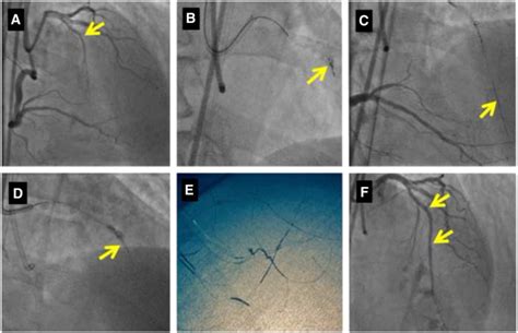 Coronary bypass graft perforation during percutaneous intervention | Thoracic Key