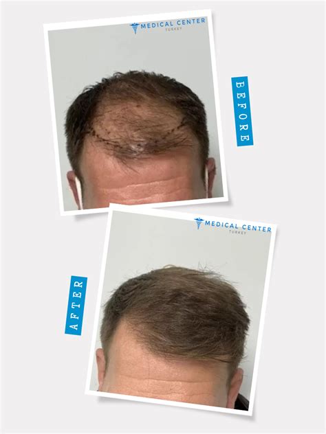 National Hair Centers Best Hair Transplant In Phoenix Artofit