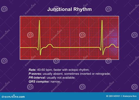 Elettrocardiogramma Con Unillustrazione A Ritmo Di Giunzione 3d