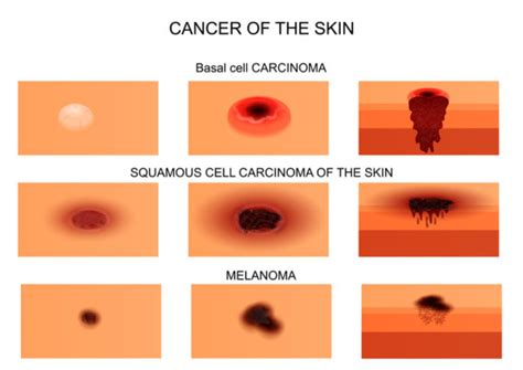 Examples Of Skin Cancer Types