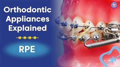 Orthodontic Appliances Explained Rpe Youtube