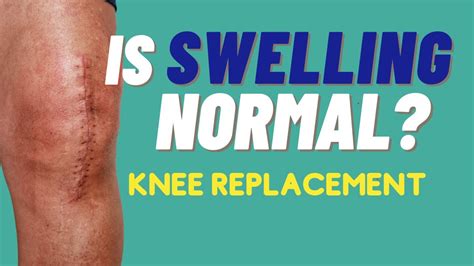 3 Tips To Reduce Swelling What Is Normal Swelling And What Is Not Knee Replacement Youtube