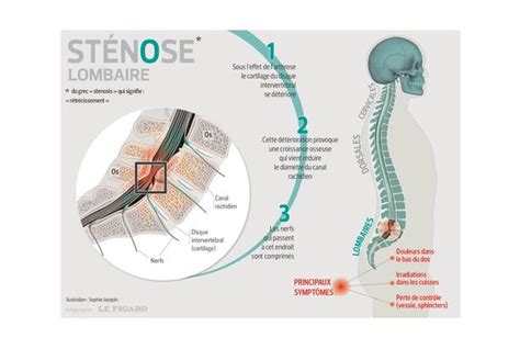 Comment reconnaître une sténose du canal lombaire