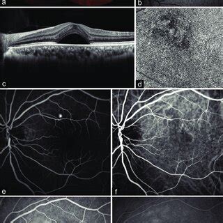 Multimodal Imaging In Patients With Central Serous Chorioretinopathy