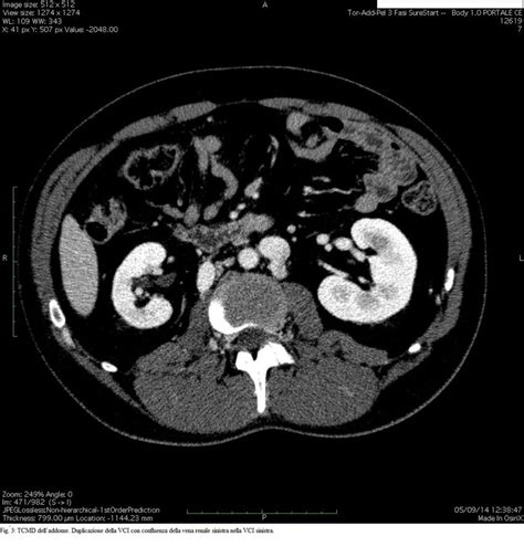 Abdominal Mdct Ivc Duplication The Left Renal Vein Terminates On Left