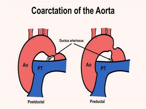 Cardiopatías Congénitas Resumen De Las Más Importantes