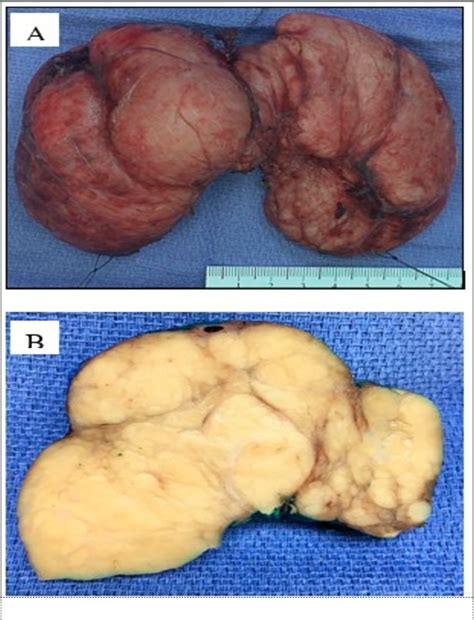 Figure 1 From Extraosseous Plasmacytoma Of Thyroid Arising In Hashimoto