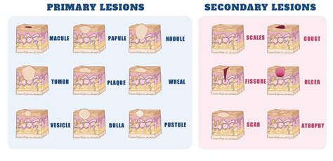 Skin Lesions Chart