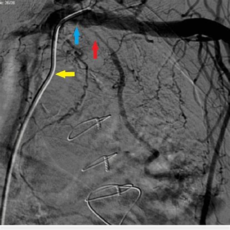 LIMA stenosis involving ostial and proximal segments LIMA: Left ...