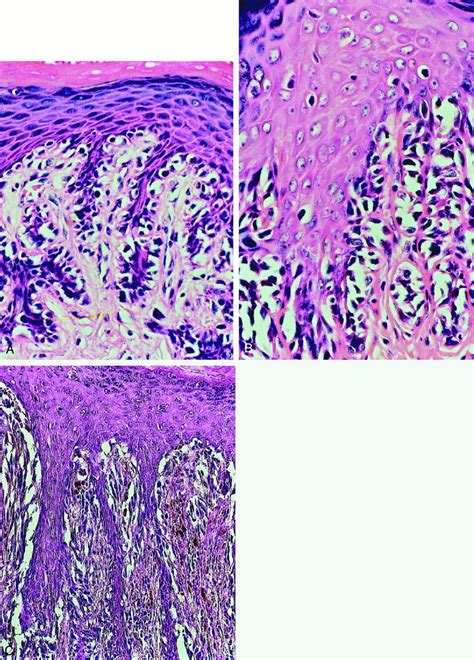 Malignant Melanoma Of The Vulva In A Nationwide Year Study Of