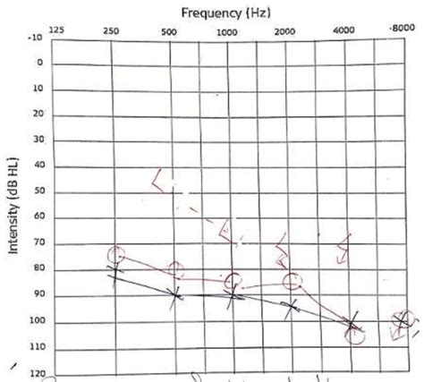 Audiogram Showing Bilateral Sensorineural Hearing Loss Download Scientific Diagram