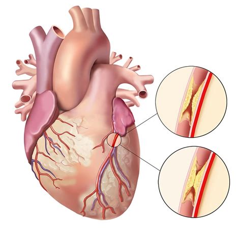 Atherosclerotic Plaque Illustration By Jackie Heda Medical