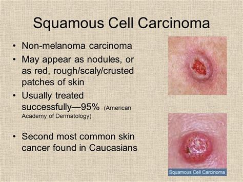 Squamous Vs Basal Cell Skin Cancer