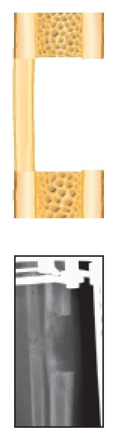 Representation Of Callus Classification Illustration And Radiographs