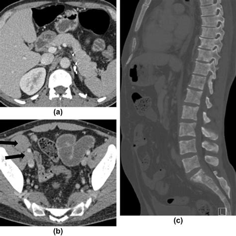 Metastatic Adult Anb In A 38 Year Old Man Left Adrenalectomy And