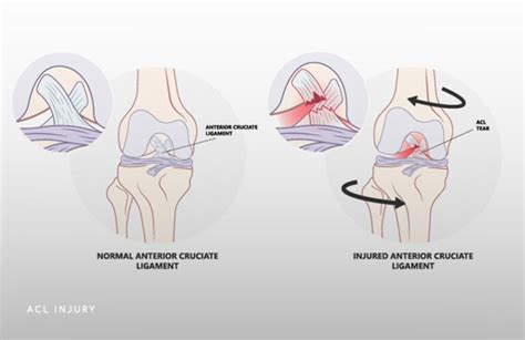 Acl Tear Schaumburg Il Thomas Obermeyer Md