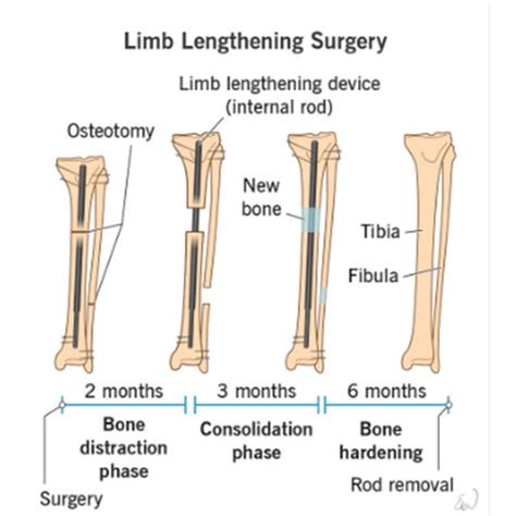 Limb Lengthening Global Healthcare India