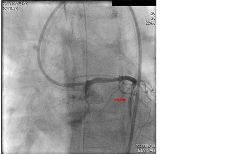 Acquired Coronary Cameral Fistula Due To Post Stent Balloon Dilatation