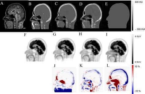 Synthetic CT Generation From T1 Weighted MR Image Using A Generative