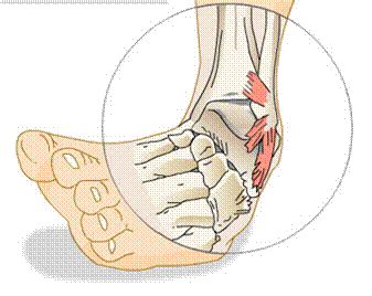 Ankle Sprain: Knowing The Symptoms and Grade