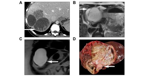 Easl Clinical Practice Guidelines On The Management Of Cystic Liver Diseases Journal Of Hepatology