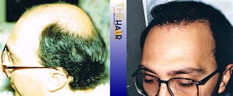 Gallery - Hair Loss Recovery by Dr. Larry Fremont