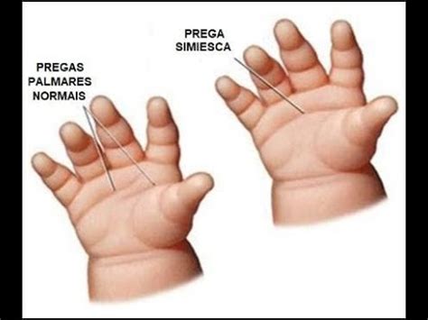 Biologia S Ndrome De Patau Ou Trissomia Do