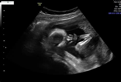 Anterior placenta normal ultrasound? - July 2022 Babies | Forums | What ...