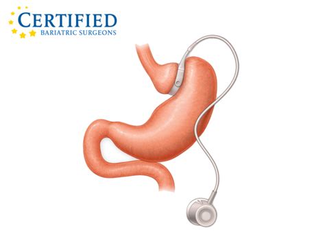 Lap Band® System Certified Bariatric Surgeons