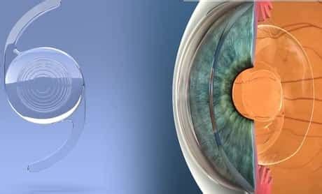 Multifocal Lens Patient Reviews – EYExan.com