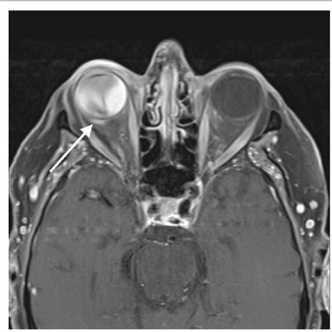 Characteristic Appearance Of Choroidal Melanoma On Mri Notes A High